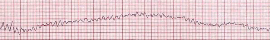 Rhythm strip showing VF from LITFL (https://litfl.com/ventricular-fibrillation-vf-ecg-library/)