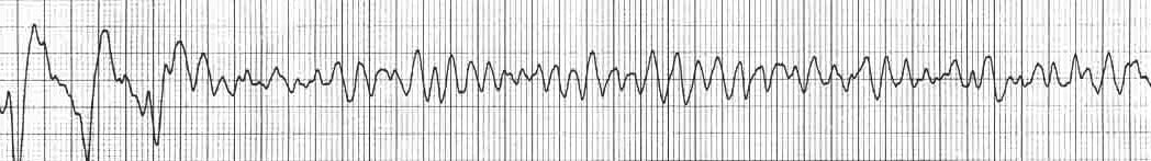 Rhythm strip showing VF from LITFL (https://litfl.com/ventricular-fibrillation-vf-ecg-library/)