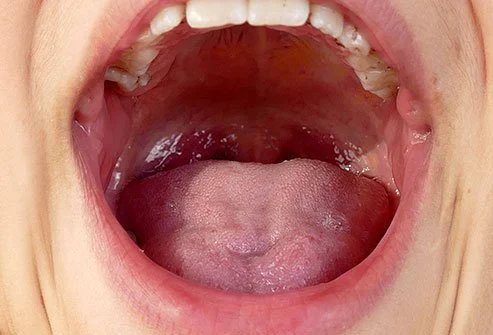 A Mallampati 3 airway